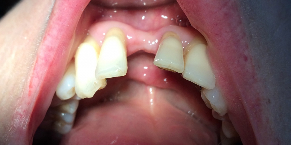  Шинирование переднего зуба (замещение временным зубом)