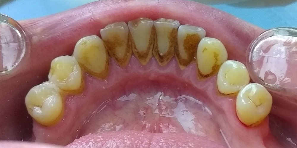  Профессиональная гигиена полости рта, результат чистки зубов