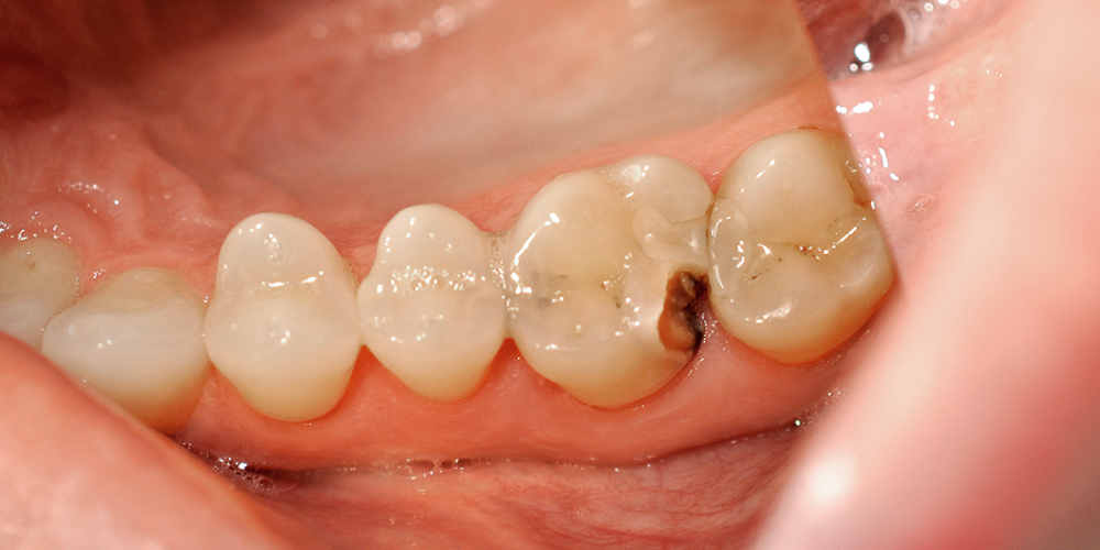  Результат лечения кариеса и замены пломбы, зуб 2.6