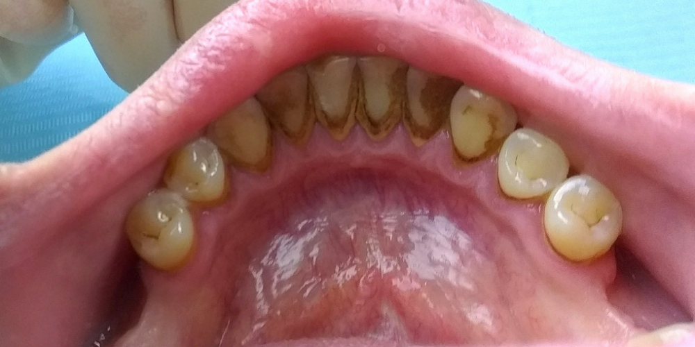  Профессиональная гигиена полости рта, фото до и после