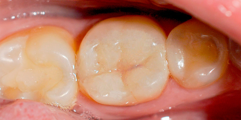  Самопроизвольные длительные ноющие боли в зубе 46