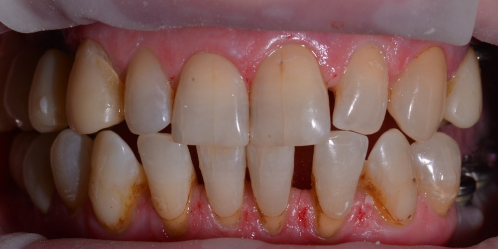  Восстановление отсутствующих зубов имплантатами и безметалловыми коронками