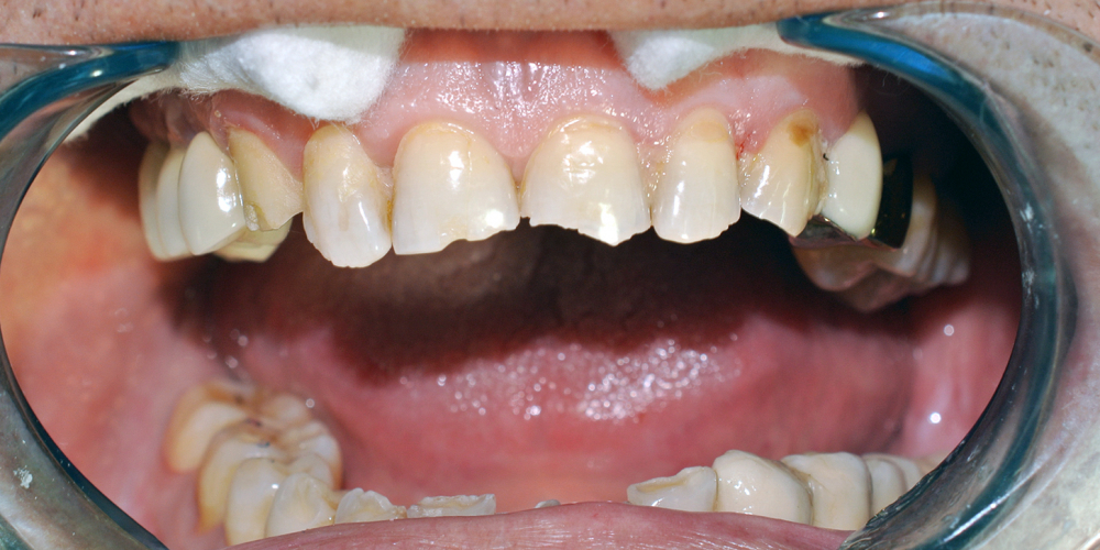  Восстановление фронтальной группы зубов пломбой