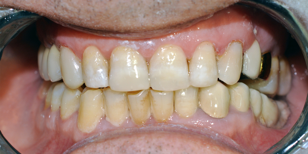  Восстановление фронтальной группы зубов пломбой