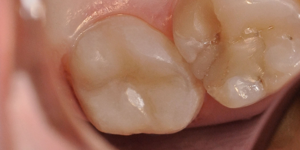  Жалобы на болевые ощущения в 27 зубе от холодных температур
