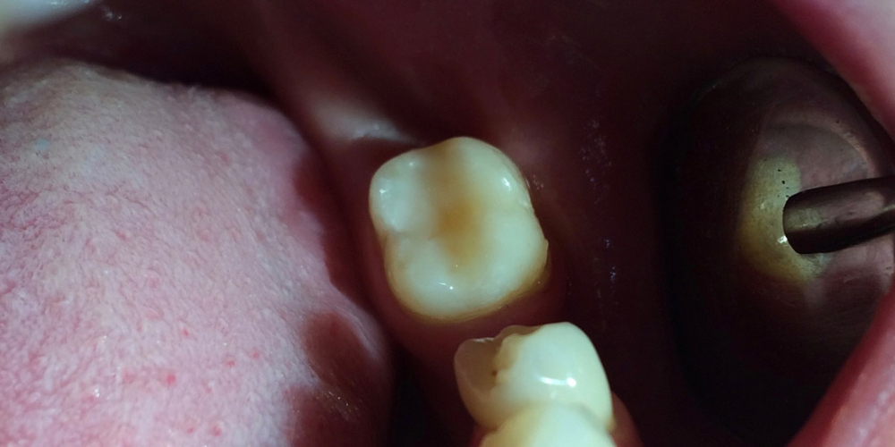  Результат лечения кариеса жевательного зуба 3.7
