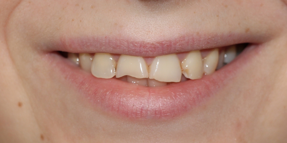  Восстановление зубов керамическими винирами