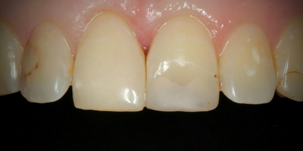  Эстетическая реставрация переднего зуба композитными материалами