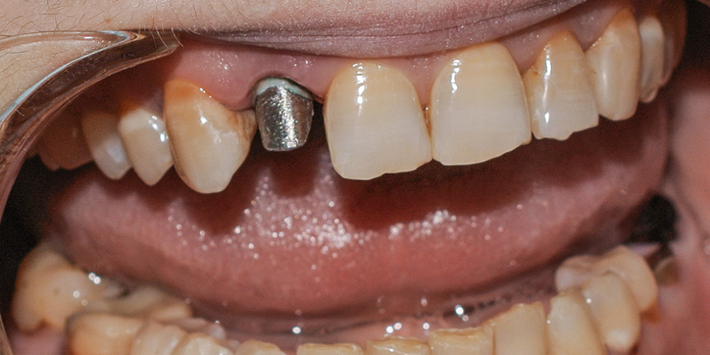  Восстановление зуба металлокерамической коронкой Noritake, Япония