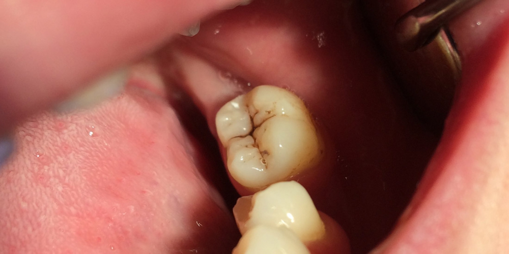  Результат лечения кариеса жевательного зуба 3.7