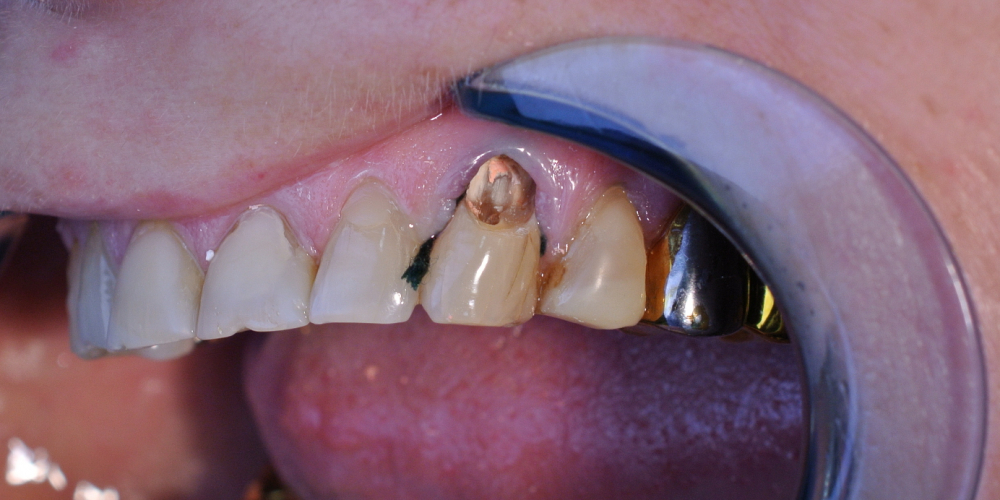  Пациентка обратилась с жалобами на боль в зубе и скол пломбы