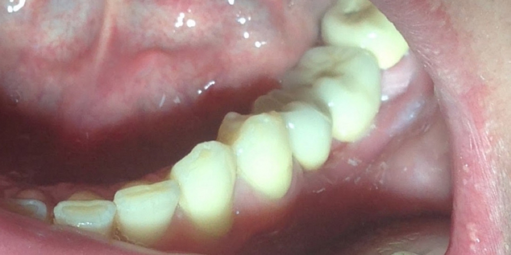  Восстановление отсутствующих зубов коронками на имплантах