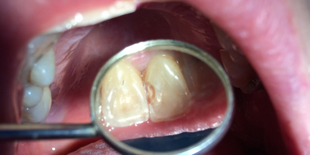  Результат замены пломбы на переднем зубе