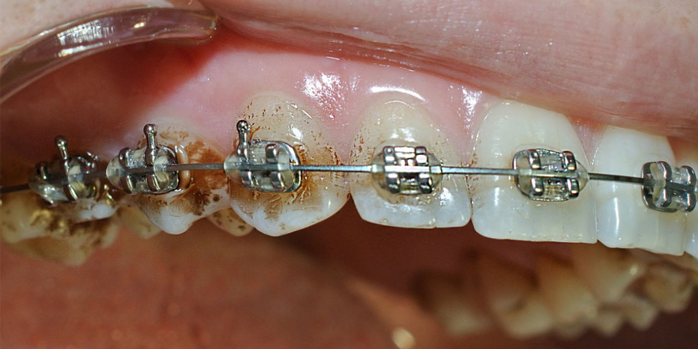  Снятие минерализованных и неминерализованных наддесневых зубных отложений
