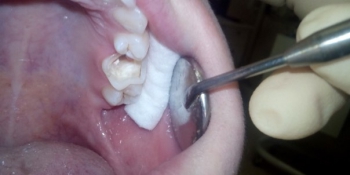 Восстановление анатомической целостности зуба фото до лечения