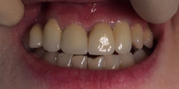 Мостовидное протезирование 6 передних зубов фото после лечения