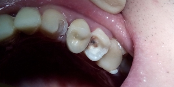 Реставрация зубов 2.3, 2.5 под инфраорбитальной анестезией фото до лечения