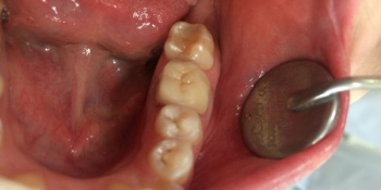 Результат лечения кариеса 35го зуба фото после лечения