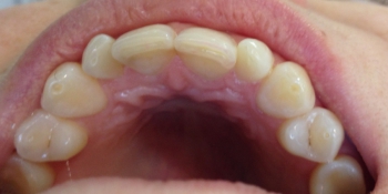 Лечение кариеса переднего зуба фото после лечения