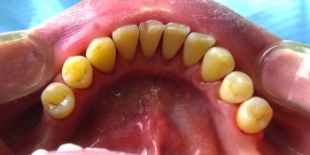 Профессиональная гигиена полости рта, результат чистки зубов фото после лечения