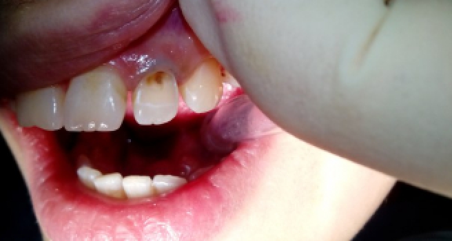 Патологический процесс твердых тканей зуба 2.2 фото до лечения