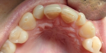 Лечение кариеса переднего зуба фото до лечения