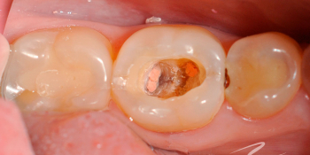 Самопроизвольные длительные ноющие боли в зубе 46 фото до лечения