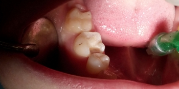 Реставрация зуба, поражено 2/3 части зуба фото до лечения
