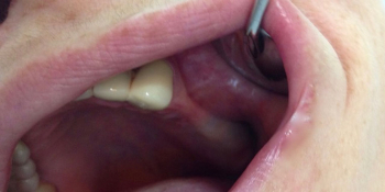Имплантация и протезирование трех зубов на имплантах фото до лечения
