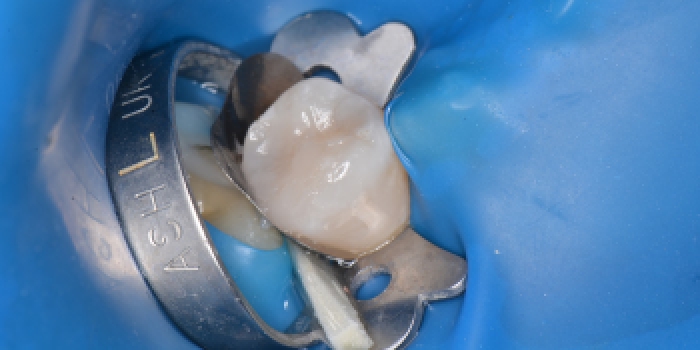 Лечение зуба с применением коффедрама фото после лечения