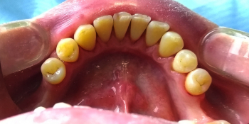 Профессиональная гигиена полости рта, фото до и после фото после лечения