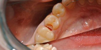 Жалобы на боль в зубе на холодное и при приеме пищи фото до лечения