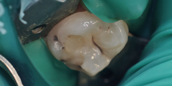 Жалобы на болевые ощущения в 27 зубе от холодных температур фото до лечения