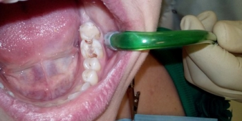 Глубокая кариозная полость зуба 3.6 фото до лечения