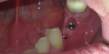 Восстановление отсутствующих зубов коронками на имплантах фото до лечения