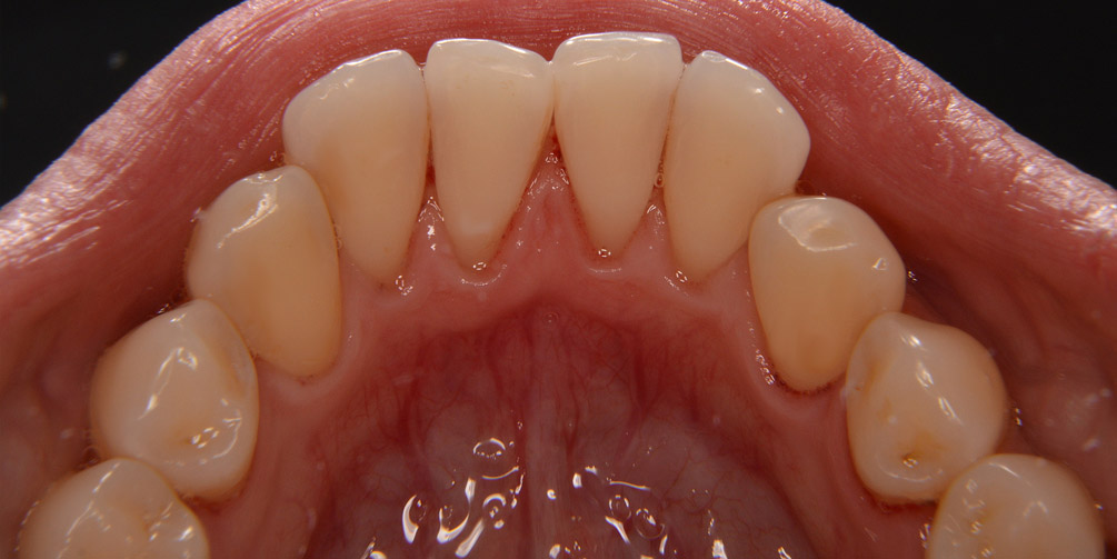 Профессиональная гигиена полости рта фото после лечения