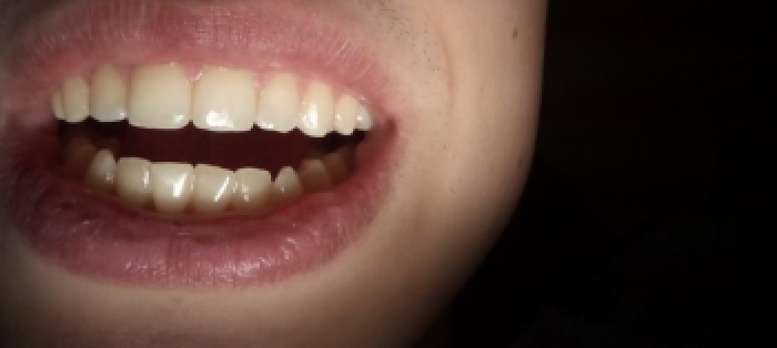 Эстетические реставрации зубов фото после лечения