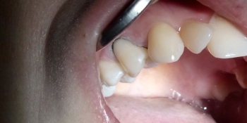 Лечение клиновидного дефекта зуба 1.4 фото после лечения