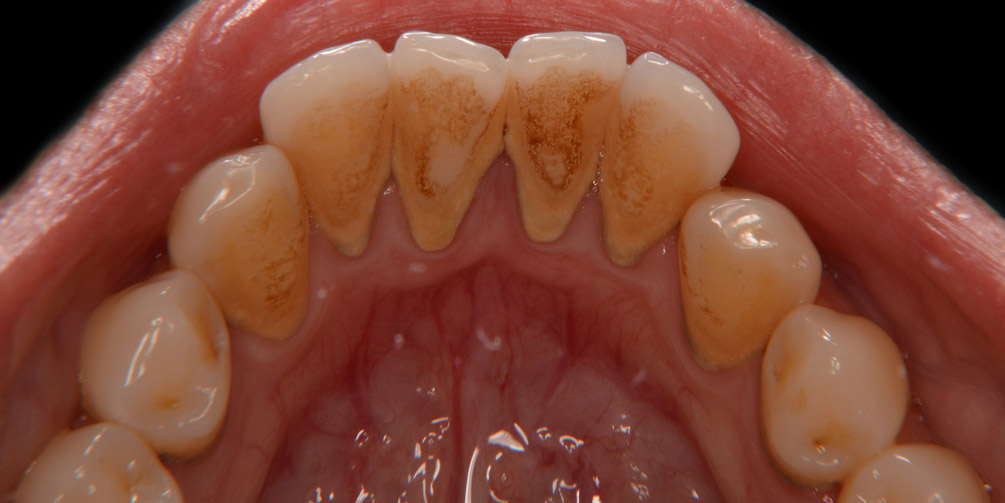 Профессиональная гигиена полости рта фото до лечения