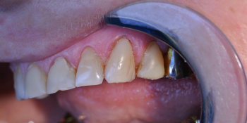 Пациентка обратилась с жалобами на боль в зубе и скол пломбы фото после лечения
