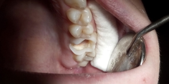 Лечение глубокого кариеса зуба 2.6 фото до лечения