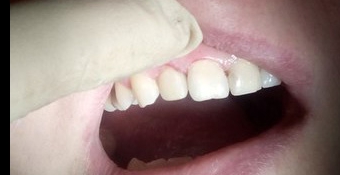 Реставрация фронтального зуба фото после лечения