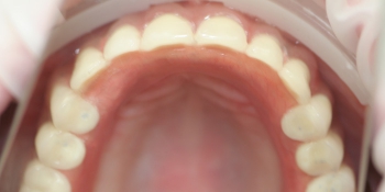 Полное отсутствие зубов, протезирование на имплататах фото после лечения