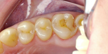 Жалобы на болевые ощущения в 17 зубе от холодных температурных раздражителей фото до лечения