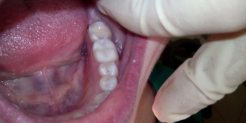 Глубокая кариозная полость зуба 3.6 фото после лечения