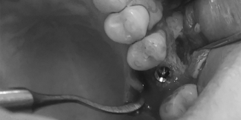Вам интересно, как выглядит зубной имплант? фото после лечения