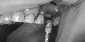 Вам интересно, как выглядит зубной имплант? фото до лечения
