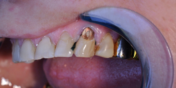 Пациентка обратилась с жалобами на боль в зубе и скол пломбы фото до лечения