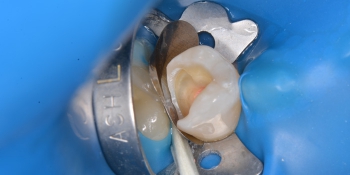 Лечение зуба с применением коффедрама фото до лечения