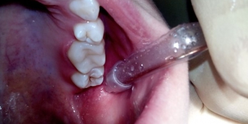 Восстановление анатомической целостности зуба фото после лечения